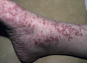 Узловатая эритема: фото, причины, лечение, осложнения, профилактика