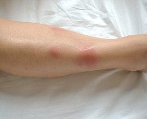 Узловатая эритема: фото, причины, лечение, осложнения, профилактика