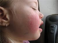 Узловатая эритема: фото, причины, лечение, осложнения, профилактика