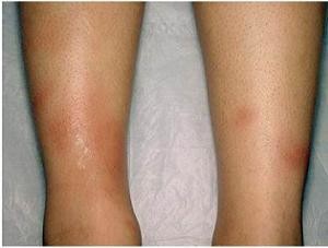 Узловатая эритема: фото, причины, лечение, осложнения, профилактика