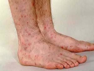 Узловатая эритема: фото, причины, лечение, осложнения, профилактика