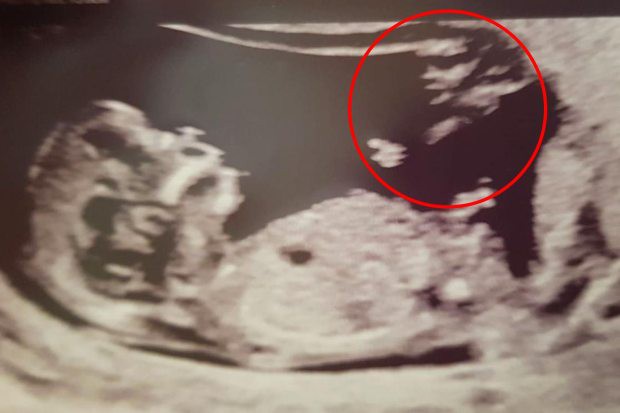 Не беременность, а чудо: на снимке УЗИ появился "ангел-хранитель"
