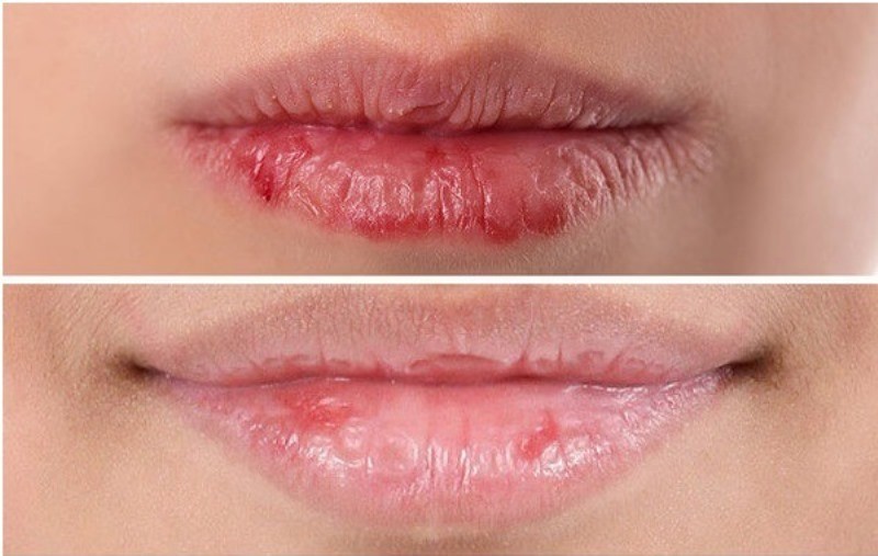 Отчего постоянно сухая кожа губ и что делать?