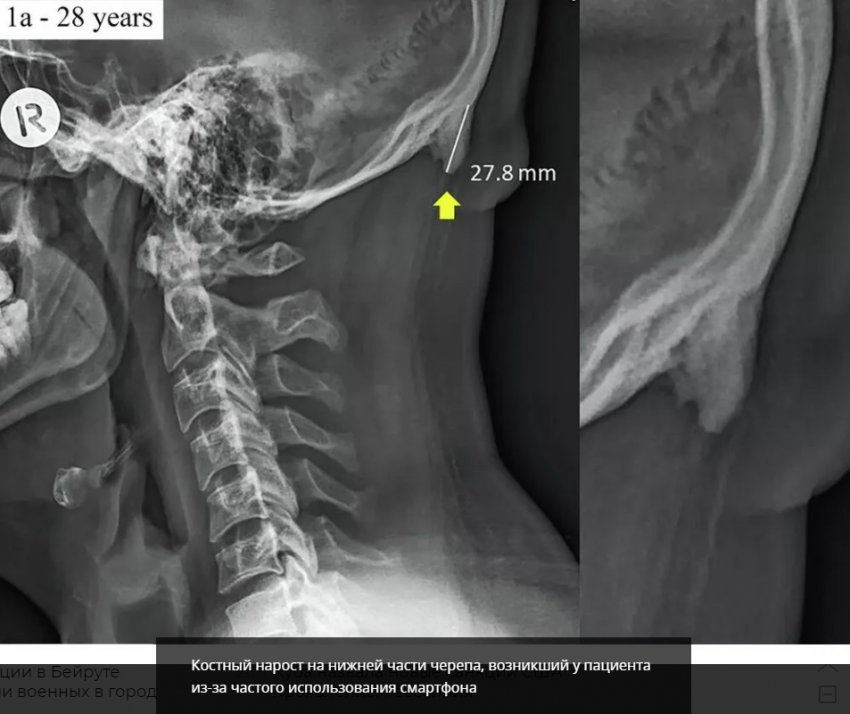 Уставший мозг, слепота и рога на голове - Побочные эффекты смартфонов
