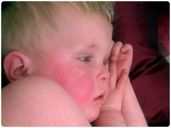 Скарлатина у детей: 3 основных признака, симптомы, диагностика, 8 методов лечения