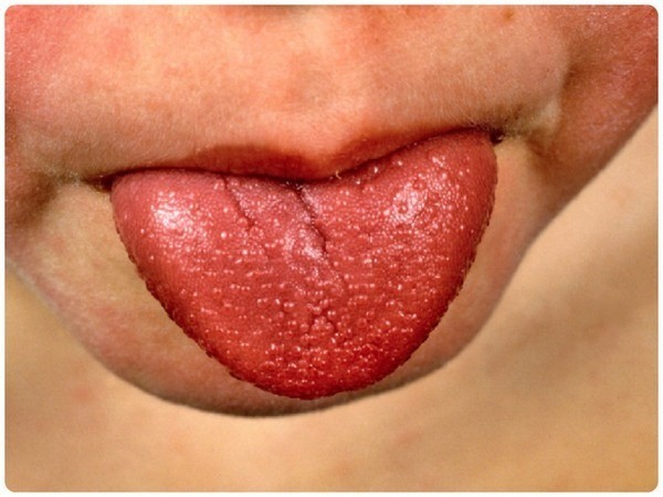 Скарлатина у детей: 3 основных признака, симптомы, диагностика, 8 методов лечения