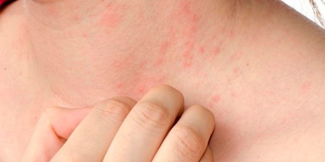 Скарлатина у детей: 3 основных признака, симптомы, диагностика, 8 методов лечения