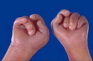 Синдром эдвардса: 10 явных признаков, обзор 3-х методов пренатальной диагностики и врачебной мнение о возможности лечения