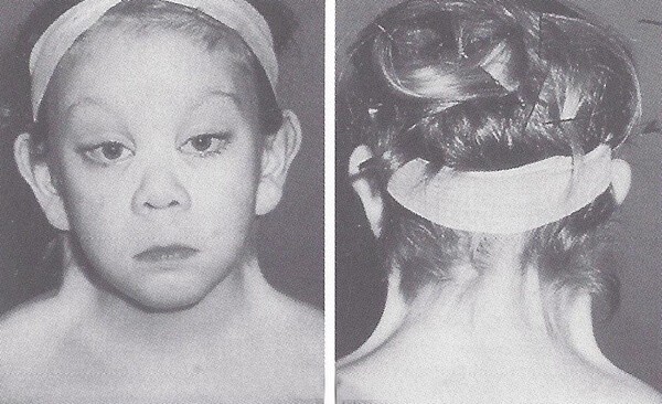 Синдром шерешевского тёрнера : 13 признаков генетического синдрома