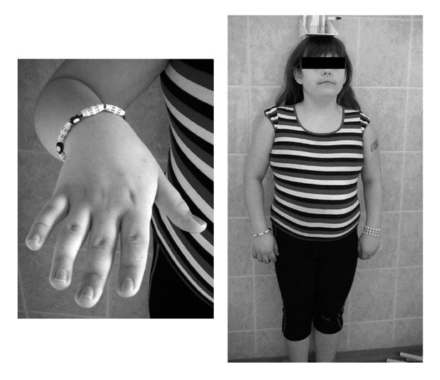 Синдром шерешевского тёрнера : 13 признаков генетического синдрома