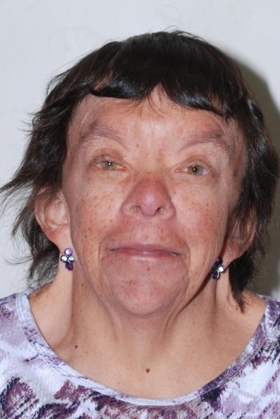 Синдром шерешевского тёрнера : 13 признаков генетического синдрома