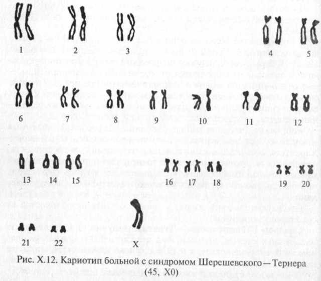 Синдром шерешевского тёрнера : 13 признаков генетического синдрома