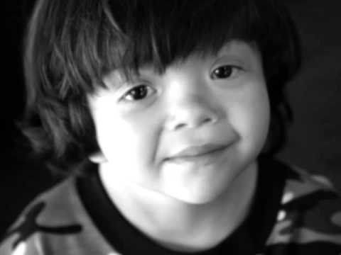 Синдром шерешевского тёрнера : 13 признаков генетического синдрома