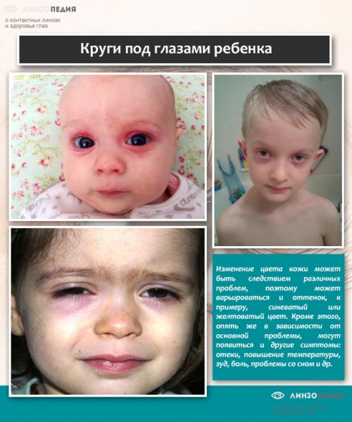 Синяки под глазами у ребенка: 12 возможных причин, методы лечения и профилактики