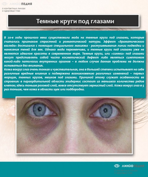 Синяки под глазами у ребенка: 12 возможных причин, методы лечения и профилактики