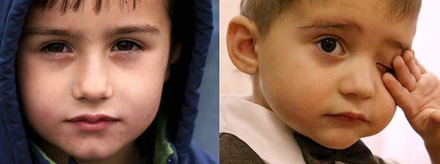 Синяки под глазами у ребенка: 12 возможных причин, методы лечения и профилактики