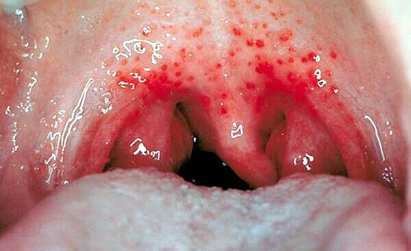 Ангина герпетическая: 5 особенностей течения и лечение у детей