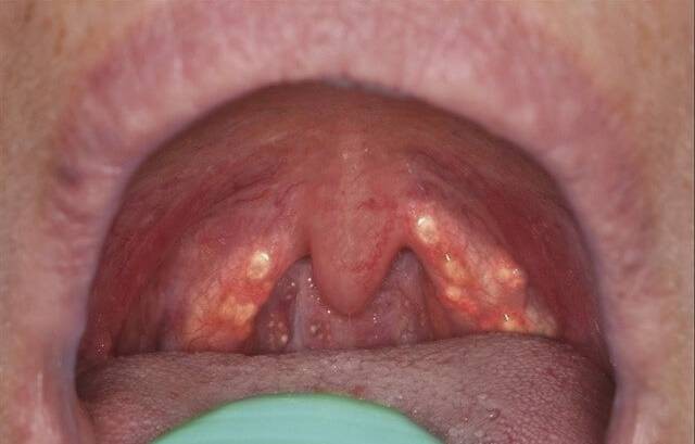 Ангина герпетическая: 5 особенностей течения и лечение у детей