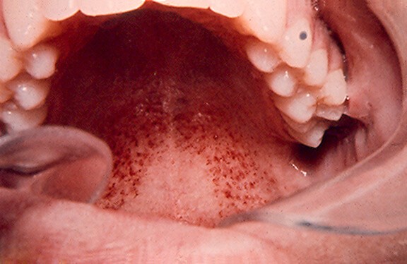 Ангина герпетическая: 5 особенностей течения и лечение у детей