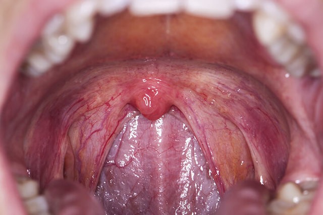 Ангина герпетическая: 5 особенностей течения и лечение у детей