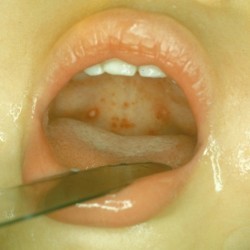Ангина герпетическая: 5 особенностей течения и лечение у детей