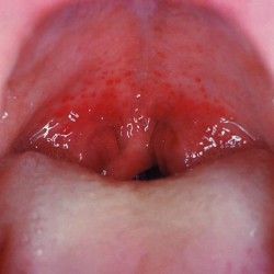 Ангина герпетическая: 5 особенностей течения и лечение у детей