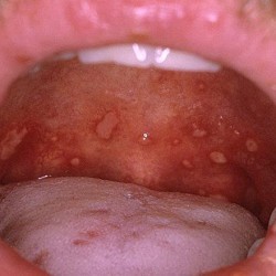 Ангина герпетическая: 5 особенностей течения и лечение у детей