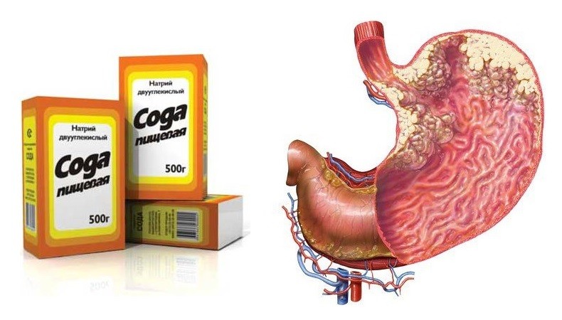 Учёные объяснили, можно ли вылечить рак содой