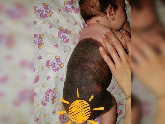 В Кургане отказались крестить ребенка с большим родимым пятном