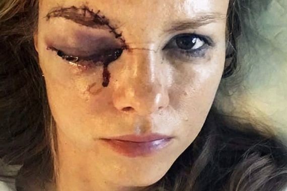 Журналистка серьезно пострадала на хоккейном матче в Словакии