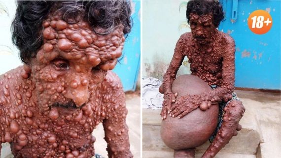 В Индии мужчина много лет живет с опухолями по всему телу