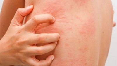 Врачи назвали признаки аллергии, которые можно спутать с другими заболеваниями