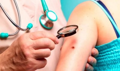 Врач-онколог назвала начальные симптомы меланомы