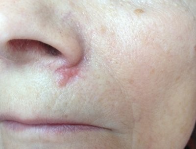 Врач-онколог рассказала, как самостоятельно распознать базалиому кожи лица