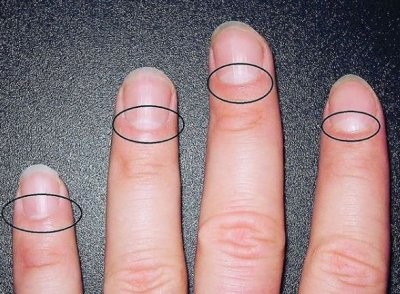 Эксперты рассказали, о каких болезнях может предупреждать исчезновение белых лунок на ногтях