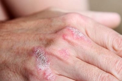 Дерматовенеролог развенчала 5 распространенных мифов о псориазе