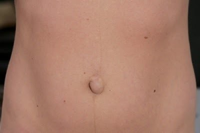 Врач рассказал, как самостоятельно по симптомам распознать пупочную грыжу