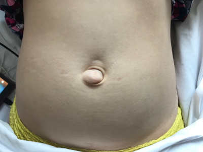 Врач рассказал, как самостоятельно по симптомам распознать пупочную грыжу