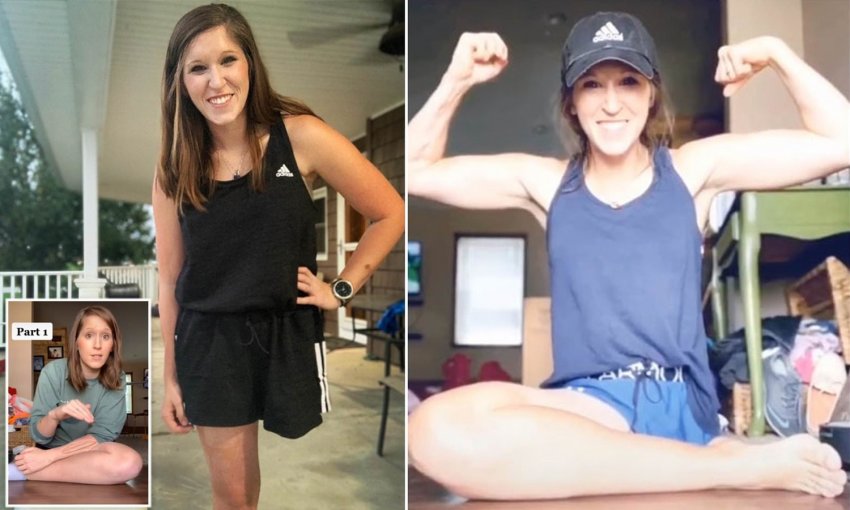 Смертоносная инфекция лишила женщину ноги и части руки