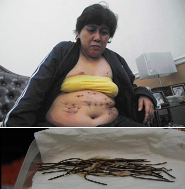 У жительницы Индонезии из тела растет металлическая проволока