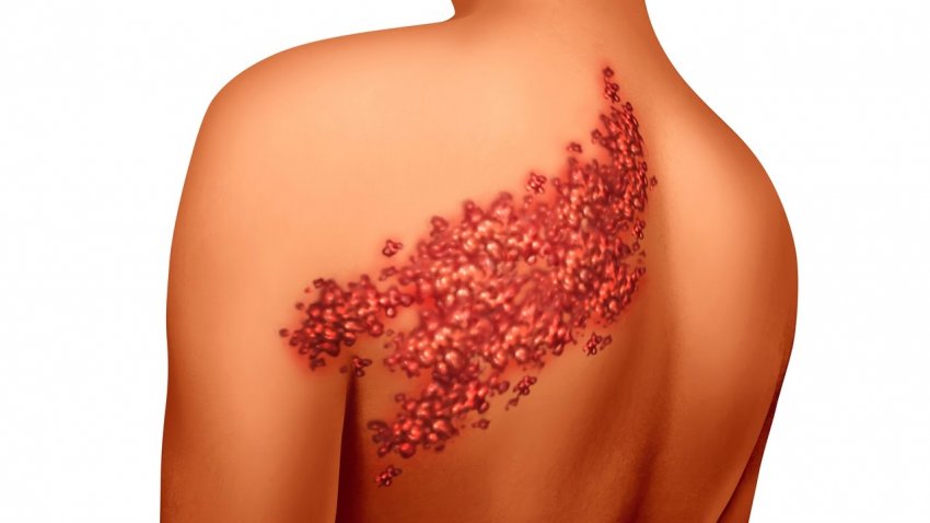 Доктор Мясников заболел опоясывающим герпесом и рассказал об этом вирусе