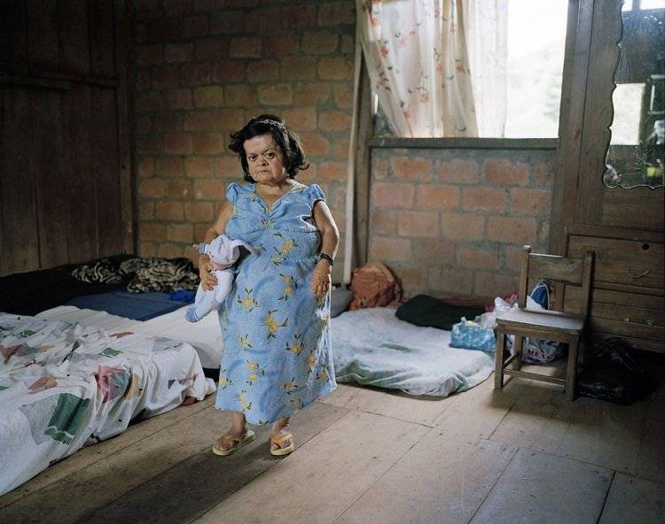 Эквадорские карлики имеют феноменальную устойчивость к двум тяжелым болезням